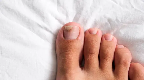  70 درصد مبتلایان به قارچ ناخن، مردان هستند/20 درصد افراد در زندگی حداقل یکبار به قارچ ناخن مبتلا می‌شوند