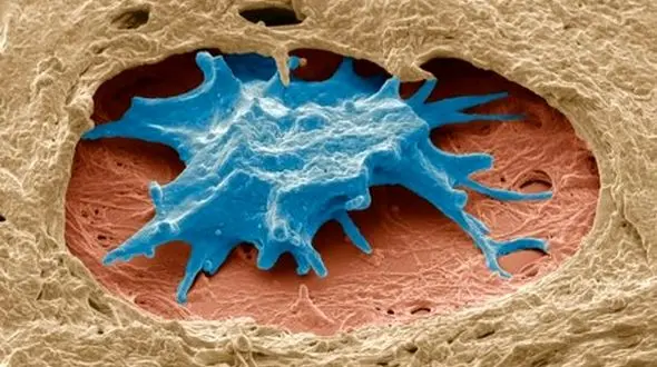 مرگبارترین سرطان زنانه قابل تشخیص شد