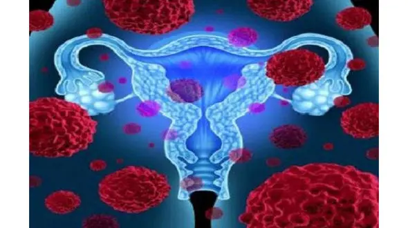 تاثیر استاتین ها در درمان سرطان تخمدان