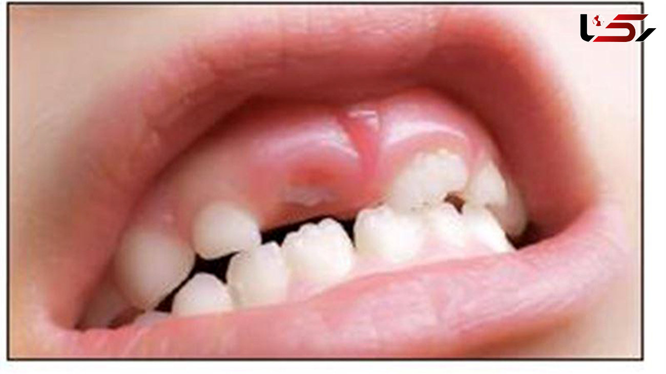 بزرگسال‌ها دوباره دندان درمی‌آورند