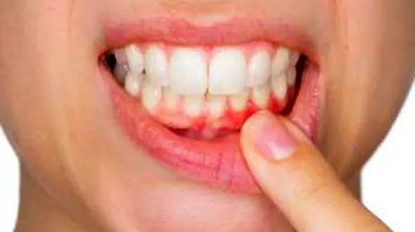 تهدید کبد با بیماری های دندان و لثه 