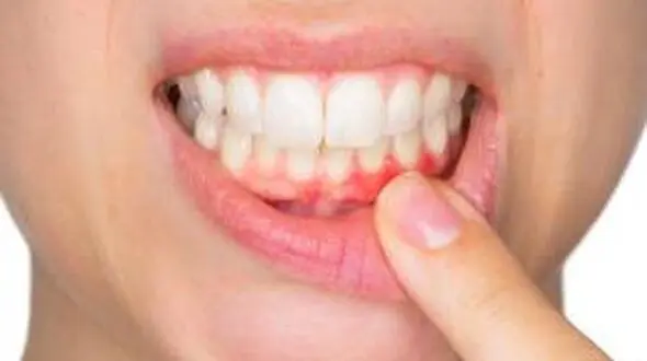 بیماری لثه قاتلی خاموش است / تنها سیگار کشیدن به بیماری لثه منتهی نمی شود
