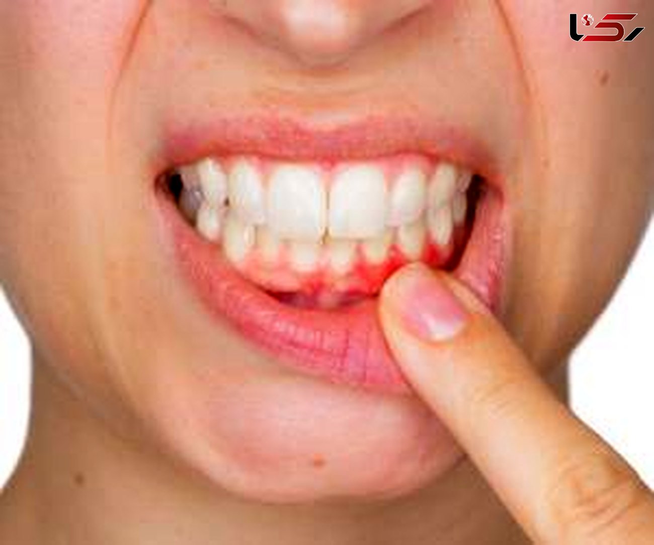 تهدید کبد با بیماری های دندان و لثه 