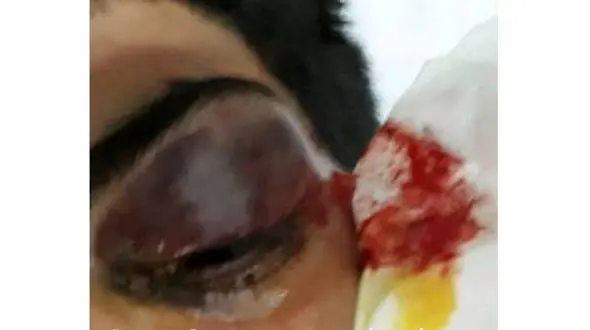 پسر کرمانی فازمتر را در چشم همکلاسی اش فرو کرد+ عکس دلخراش