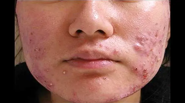 طب سوزنی و درمان آکنه 
