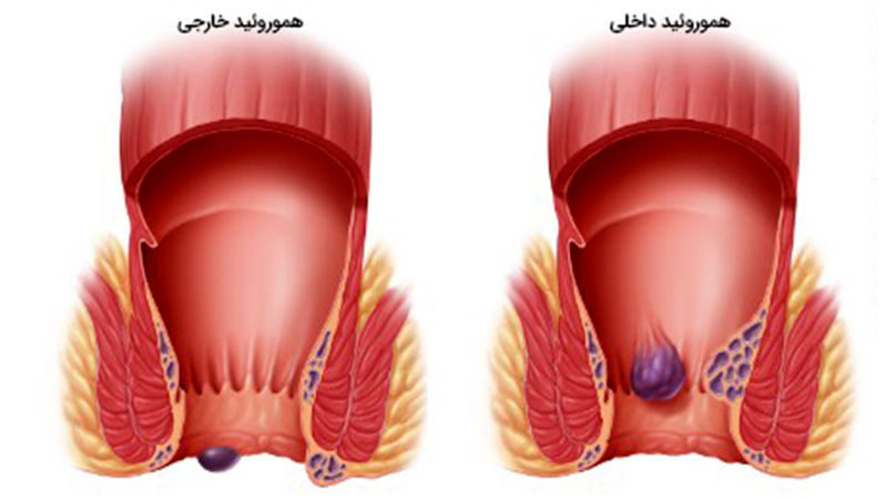 بواسیر خارجی و داخلی