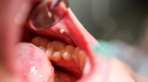  عدم رسیدگی به دندان ها به سرطان دهان منجر می شود/ سیگار و الکل و نشستن دندان ها افسار سرطان دهان را به دست گرفته اند  