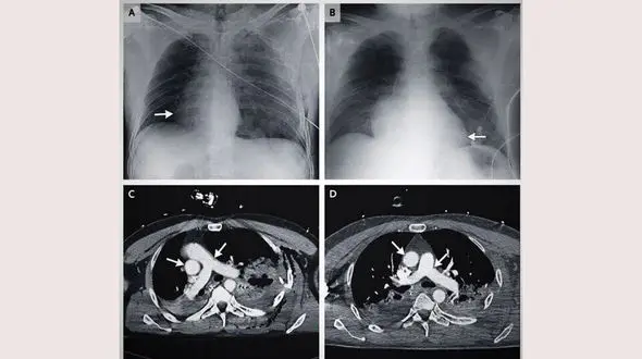 جا به جا شدن قلب یک مرد در تصادف + عکس دیدنی / ایتالیا