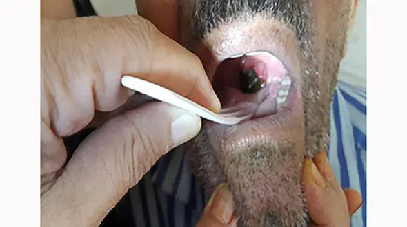 زالوی 5 سانتی 5 روز در حلق جوان کنگاوری جا خوش کرده بود ! + عکس