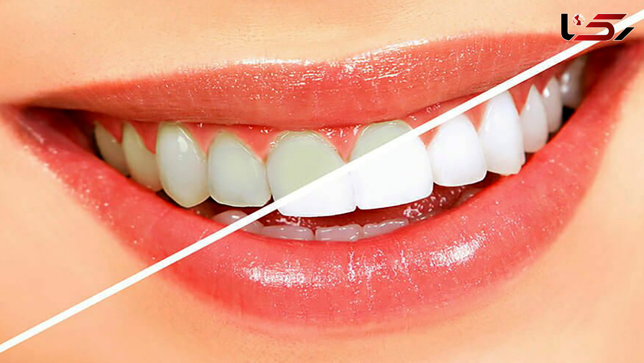 توصیه های مهم در سلامت دندان ها