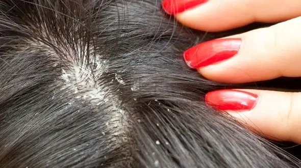 دلایل ایجاد شوره‌ سر / عادت‌ های روزانه‌ ای که به آن دقت نمی‌ کنیم