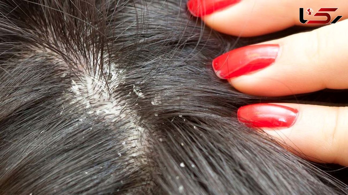  دلایل ایجاد شوره‌ سر / عادت‌ های روزانه‌ ای که به آن دقت نمی‌ کنیم 