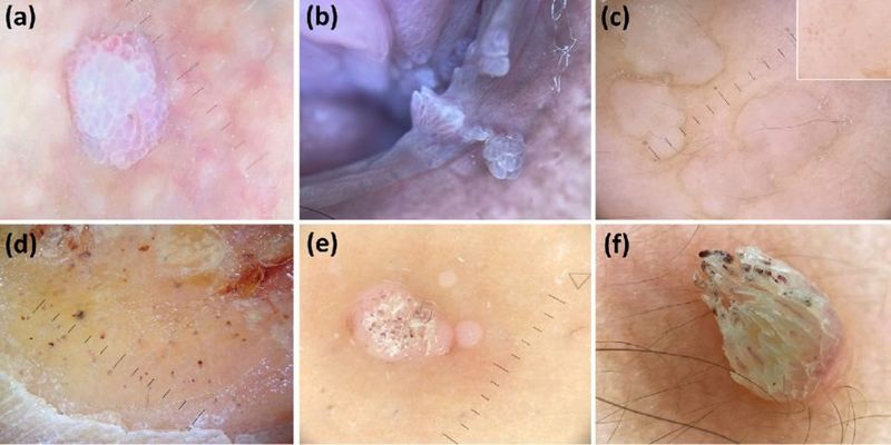 HPV یا زگیل تناسلی