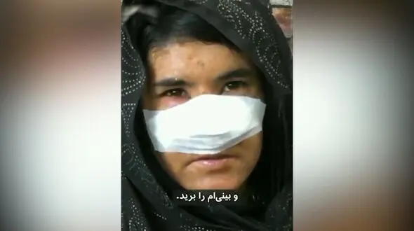 بریدن بینی زن افغان توسط شوهر بدبین+ فیلم دردناک که جهان را تکان داد