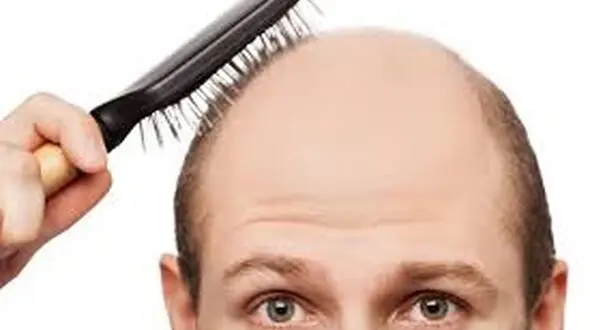 دلایل اصلی ریزش مو که نادیده گرفته می شوند
