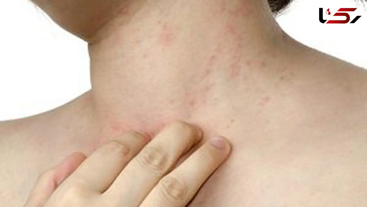 رابطه مستقیم استرس و اگزما