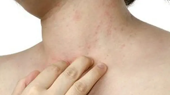 رابطه مستقیم استرس و اگزما