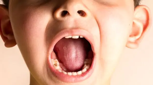 ارتباط سلامت دندان‌ های شیری با رشد کودک؛ نکاتی که نمی‌ دانید