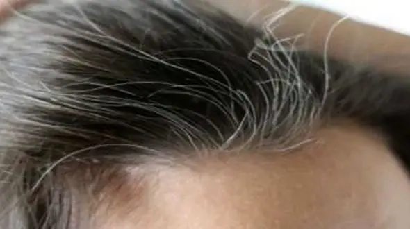 فرار شپش ها با این نسخه گیاهی