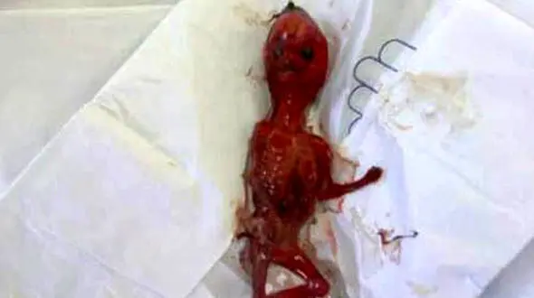 عکس دردناک از جنین  کشف شده در دستشویی دبیرستان دخترانه+ جزییات