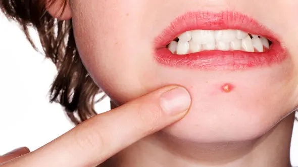 جوش صورت نشان دهنده چیست؟