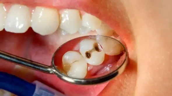 چگونه از 5 اشتباه رایج پوسیدگی دندان جلوگیری کنیم؟