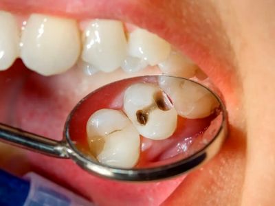 چگونه از 5 اشتباه رایج پوسیدگی دندان جلوگیری کنیم؟
