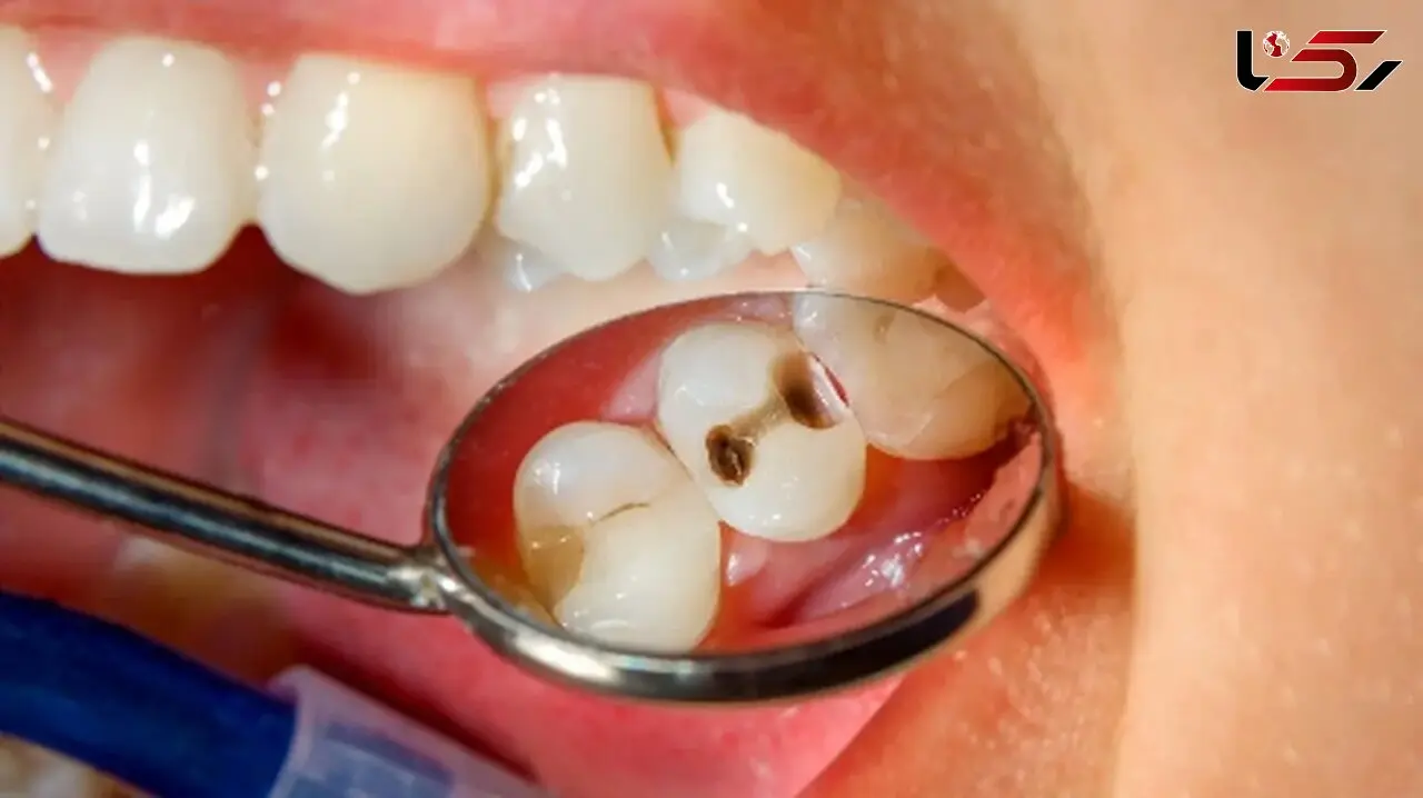 چگونه از 5 اشتباه رایج پوسیدگی دندان جلوگیری کنیم؟