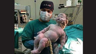 عکس نوزاد تازه متولد شده 8 کیلو 600 گرمی که گینس را جابجا کرد / این زایمان طبیعی همه را شوکه کرد