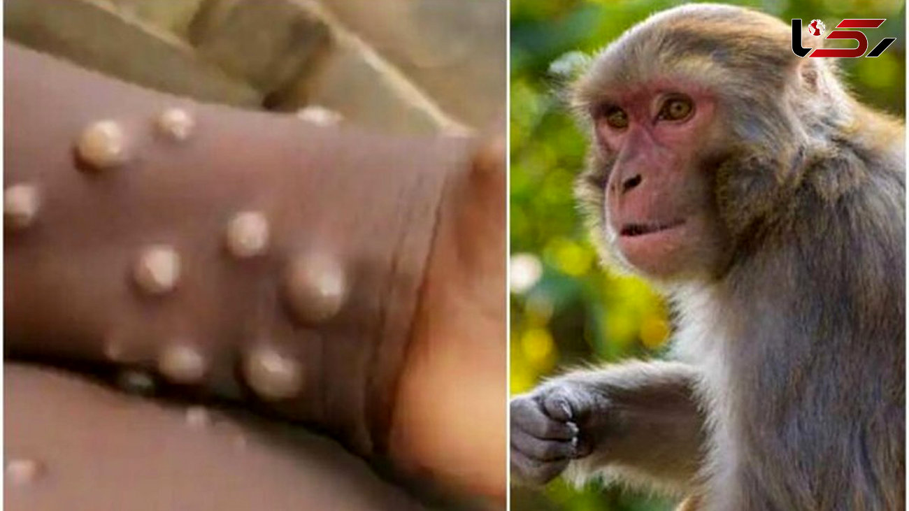 غربالگری ۸۱ نمونه مشکوک آبله میمون در انستیتو پاستور / هنوز نمونه مثبتی از آبله میمون در ایران شناسایی نشده است