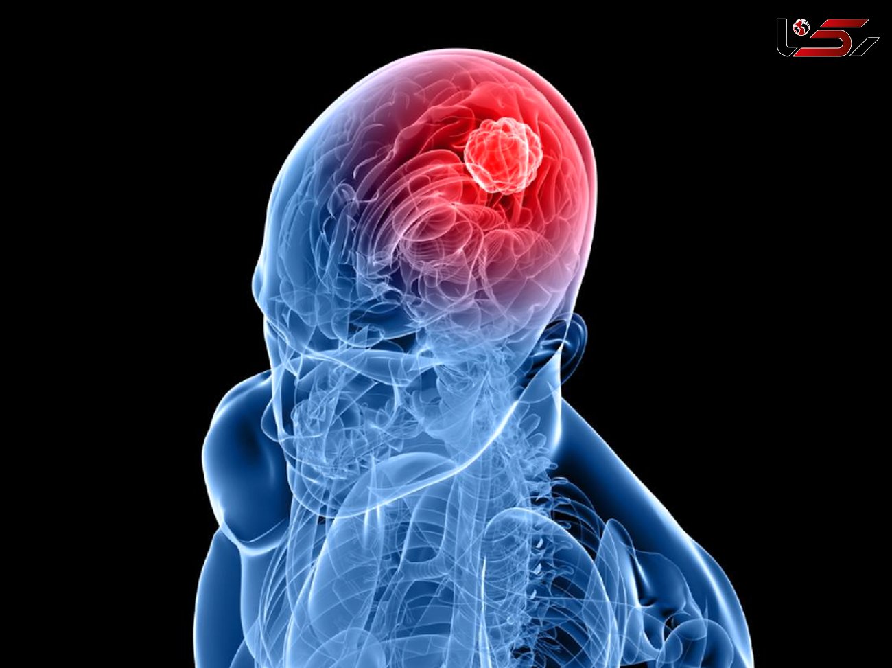 زنگ خطر ابتلا به تومور مغزی را بشناسید