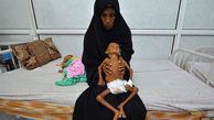  Child Malnutrition Reaches New Highs in Parts of Yemen: UN Survey 