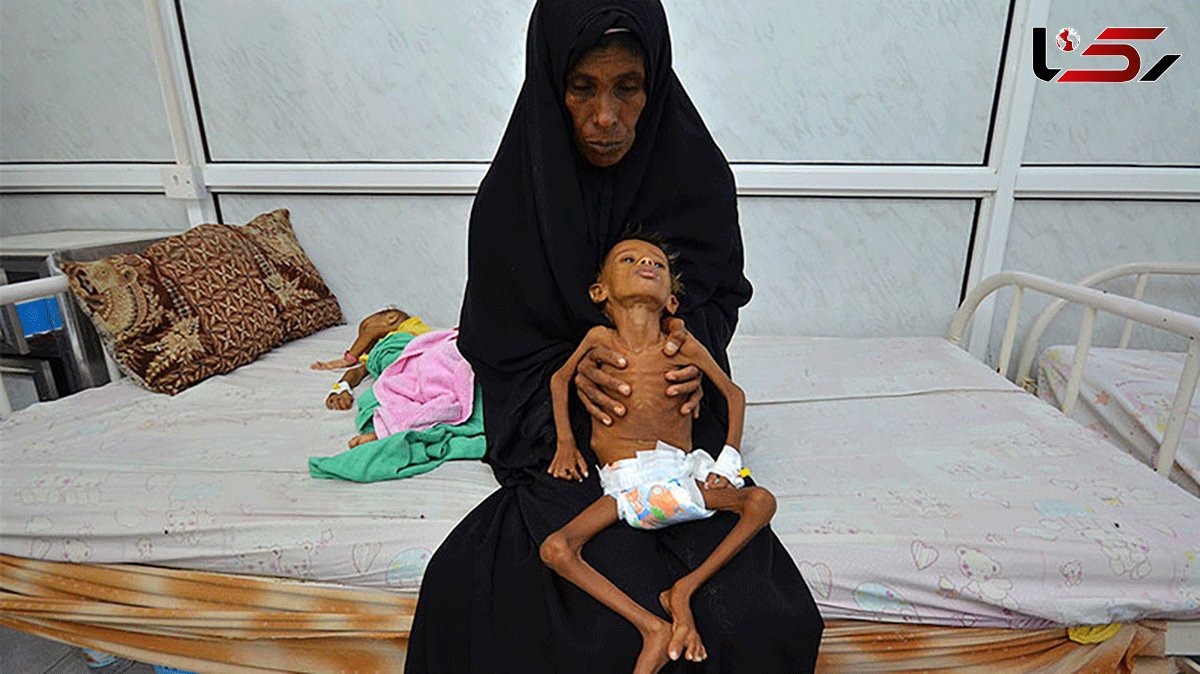  Child Malnutrition Reaches New Highs in Parts of Yemen: UN Survey 