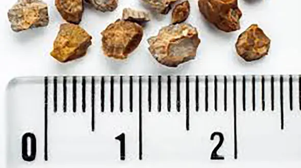 با این مواد غذایی در کلیه هایتان سنگ ایجاد کنید!