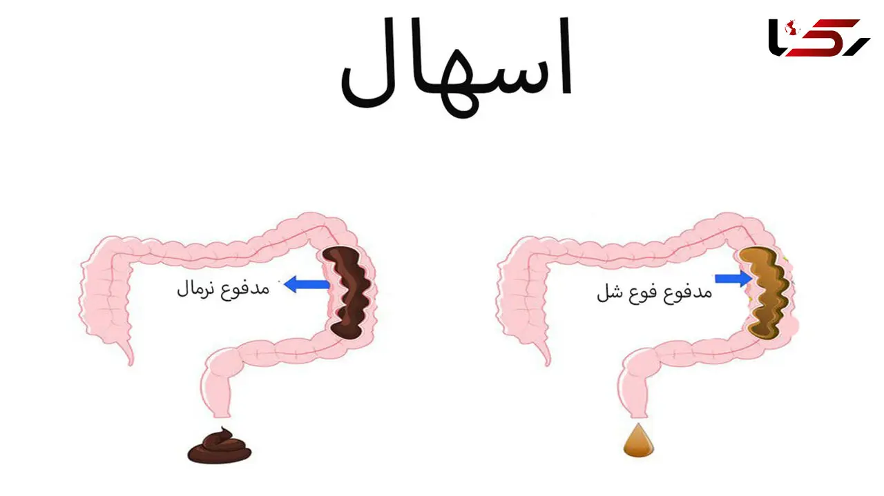 شایع ترین دلایل ابتلا به اسهال / انواع اسهال