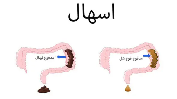 شایع ترین دلایل ابتلا به اسهال / انواع اسهال