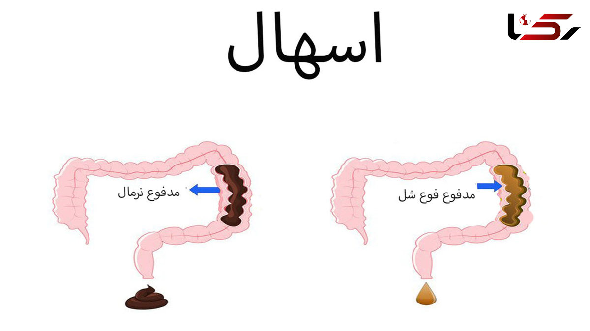 شایع ترین دلایل ابتلا به اسهال / انواع اسهال