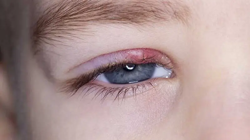 چگونه گل مژه را از بین ببریم؟