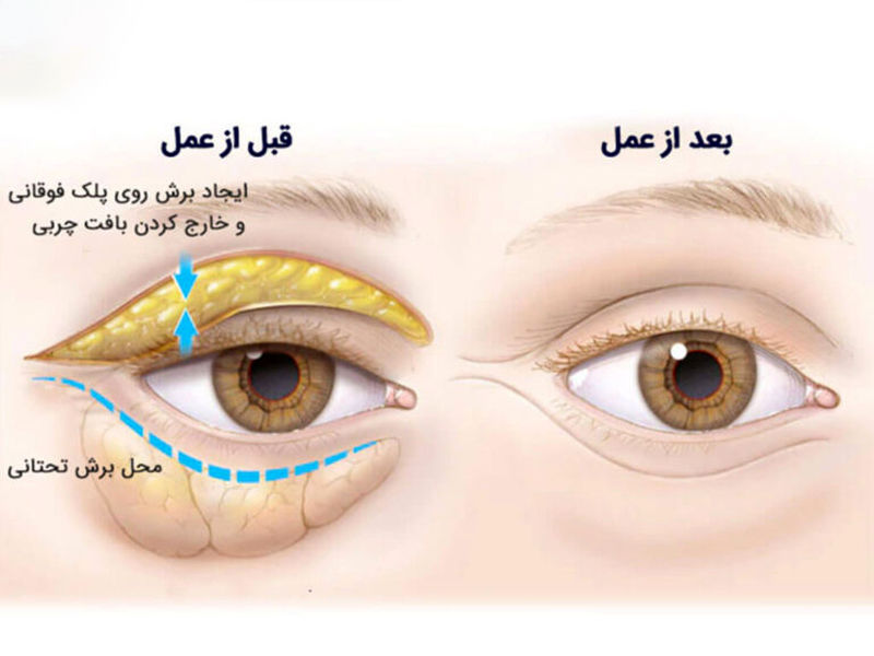 بلفاروپلاستی چیست؟