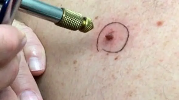 ابتلا به زگیل تناسلی  به 17 سال رسید/ تصمیم گیری آموزش و پرروش و وزارت بهداشت برای واکسن گارداسیل دانش آموزان روی هواست/  نوجوانان در معرض خطر خاموش!