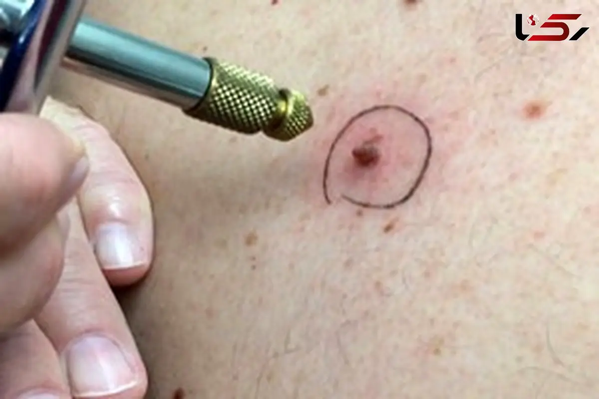 ابتلا به زگیل تناسلی  به 17 سال رسید/ تصمیم گیری آموزش و پرروش و وزارت بهداشت برای واکسن گارداسیل دانش آموزان روی هواست/  نوجوانان در معرض خطر خاموش!