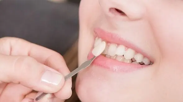 لمینیت دندان برای چه افرادی توصیه می شود؟