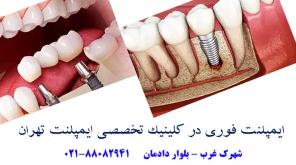 ایمپلنت فوری یک روزه دندان چیست؟