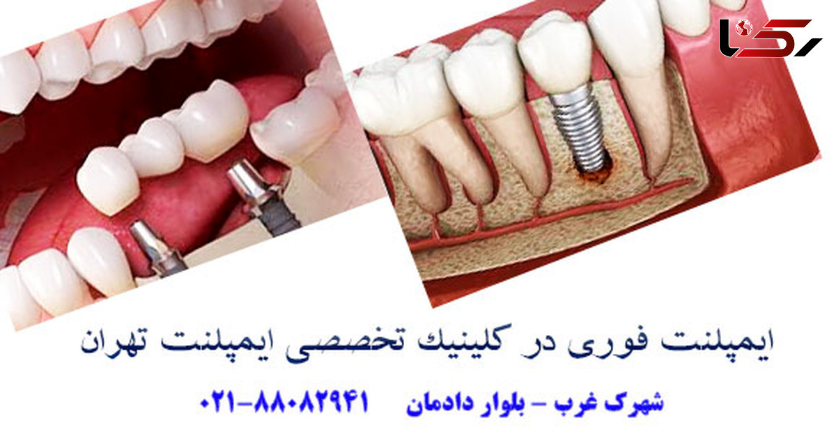 ایمپلنت فوری یک روزه دندان چیست؟