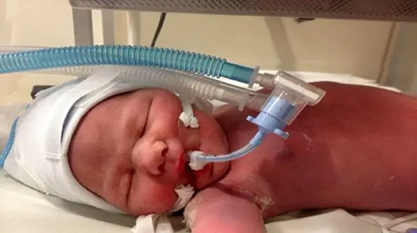 احتمال آسیب ریوی نوزادان متولدشده از مادران دارای کرونای شدید / تهدید حیات جنین با ابتلای مادران به کرونای شدید