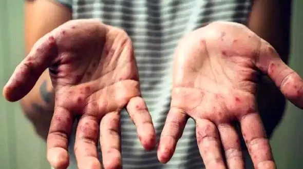 آبله میمون چه علائمی دارد؟ / مهمترین راهکارهای پیشگیری از آبله میمون 