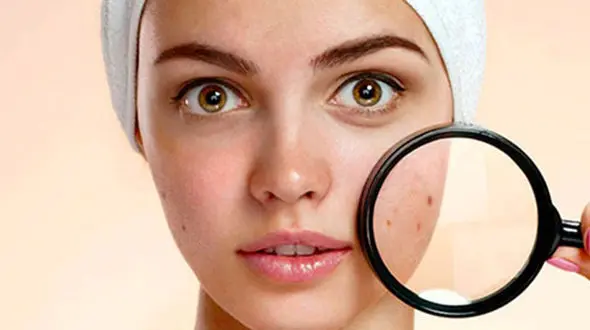 خال‌های مزاحم خود را با این روش های ساده نابود کنید!