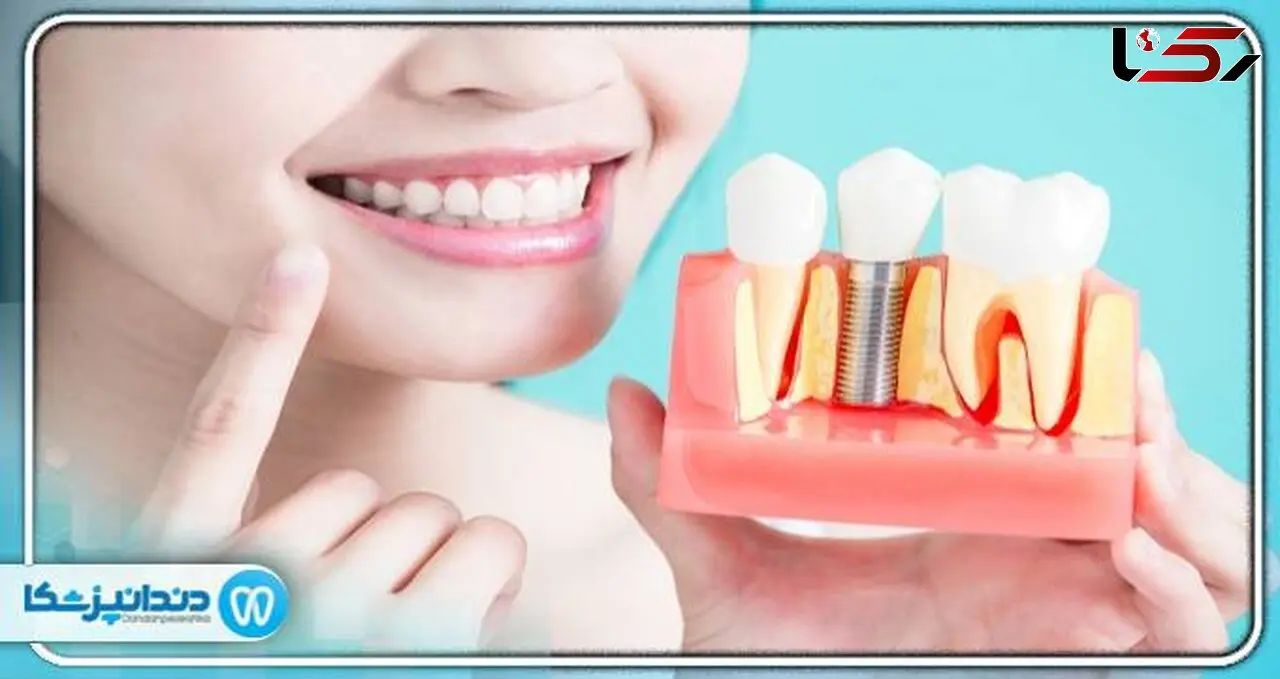 آیا می توانیم بعد از ایمپلنت به ورزش ادامه دهیم؟