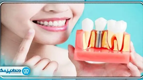 آیا می توانیم بعد از ایمپلنت به ورزش ادامه دهیم؟