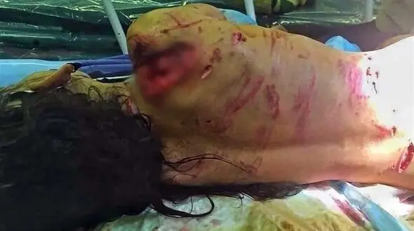 توضیحات شهرداری درباره حمله سگ‌های ولگرد به یک دختربچه + عکس